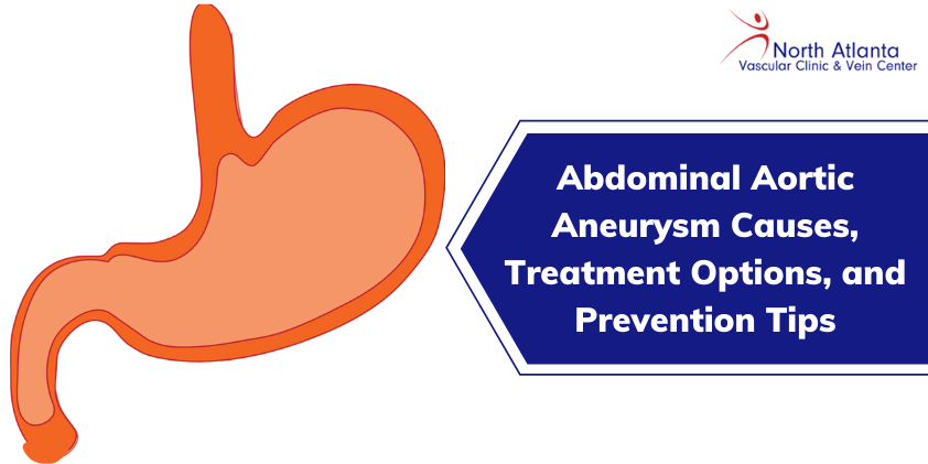 Abdominal Aortic Aneurysm: Causes, Treatment Options, and Prevention Tips