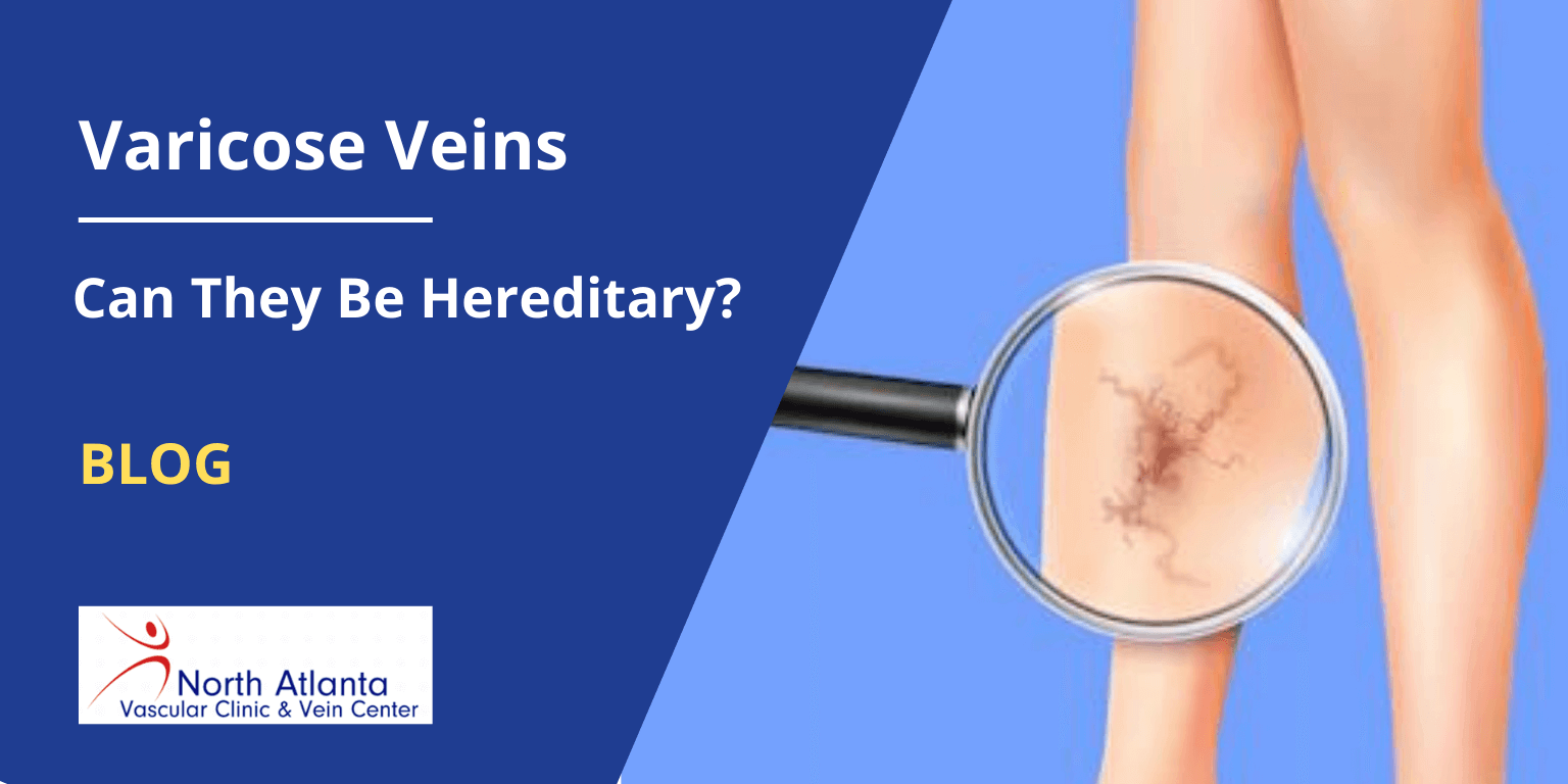 Varicose Veins: Can They Be Hereditary?