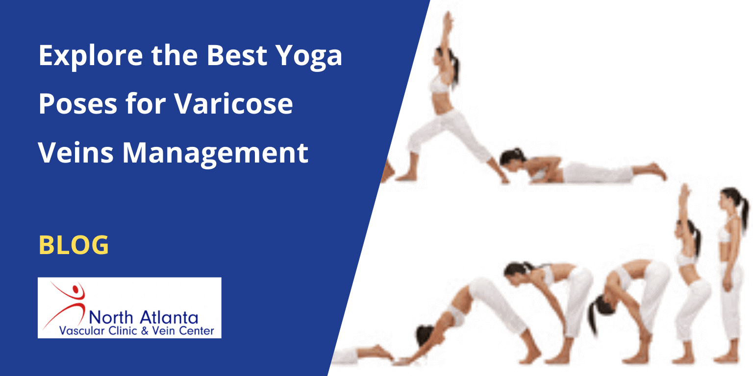 Explore the Best Yoga Poses for Varicose Veins Management