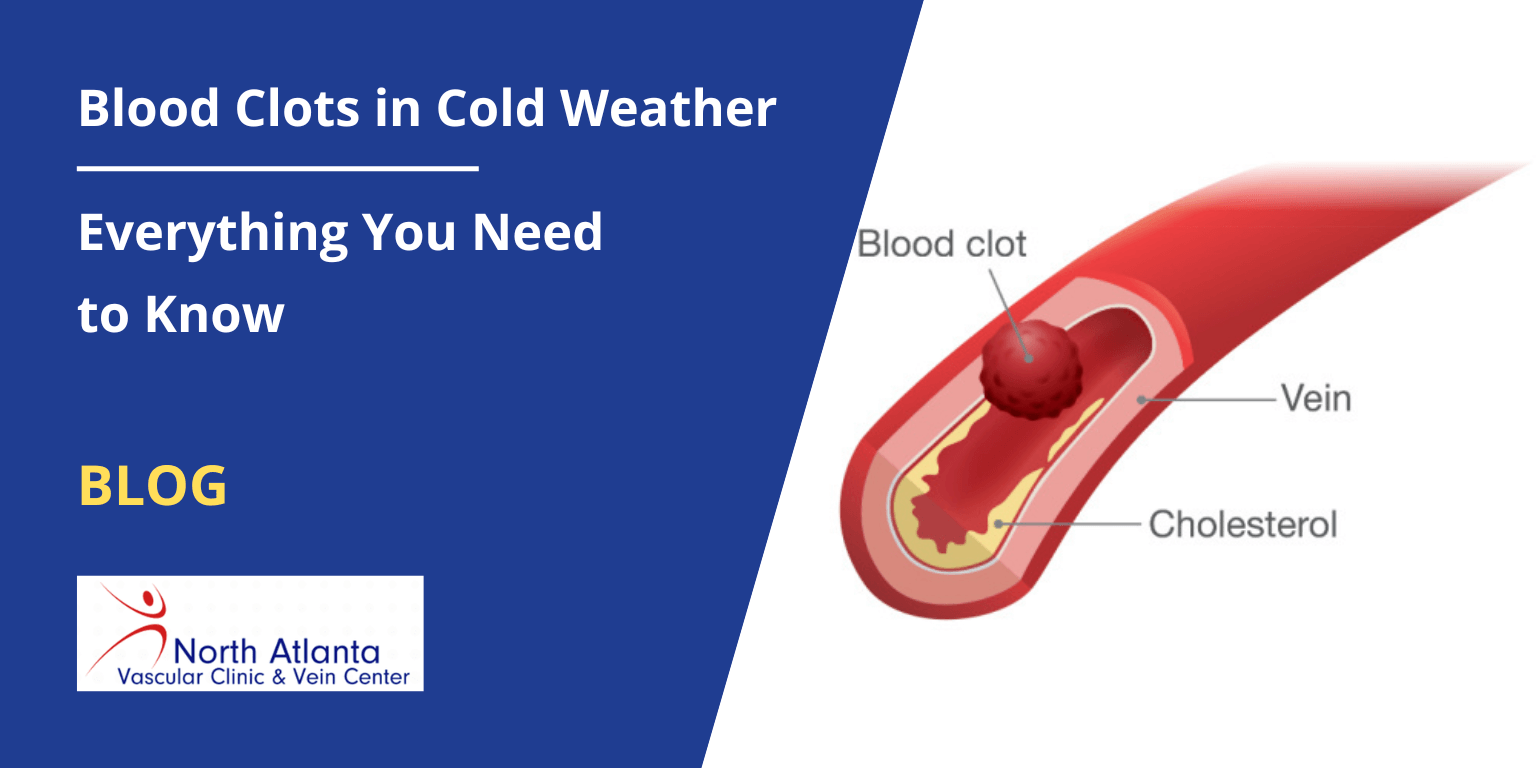 Blood Clots in Cold Weather: Everything You Need to Know