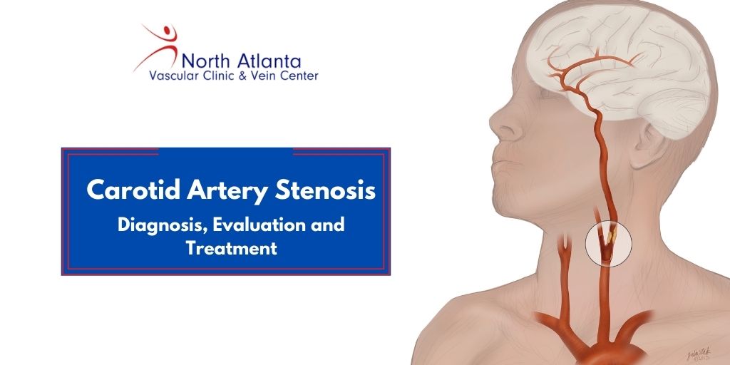 carotid stenosis