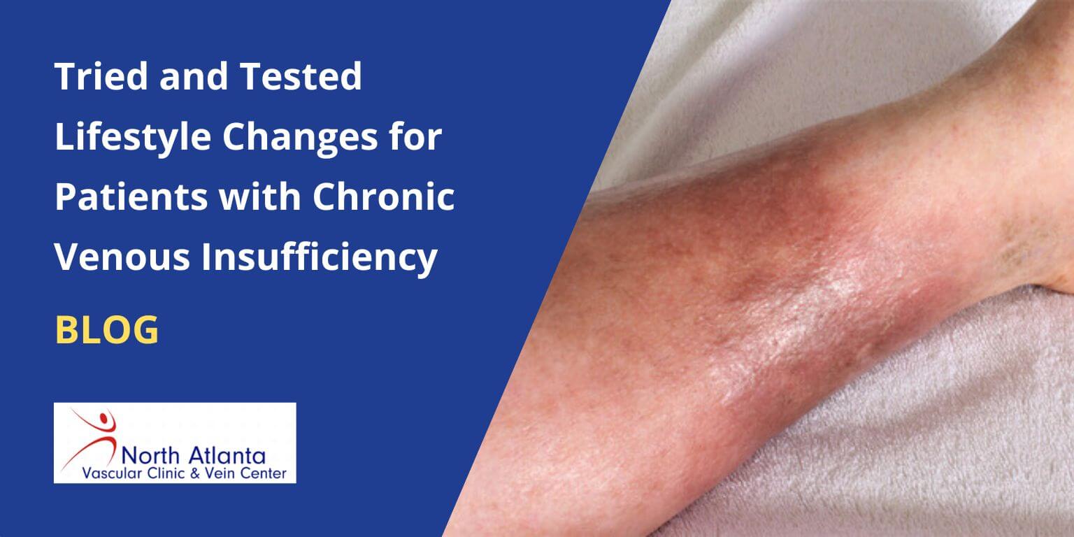 Tried and Tested Lifestyle Changes for Patients with Chronic Venous Insufficiency