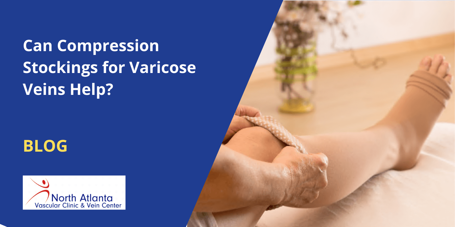 Can Compression Stockings for Varicose Veins Help?