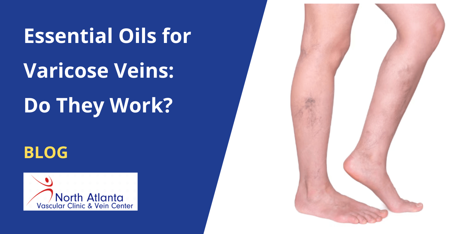 Essential Oils for Varicose Veins: Do They Work?