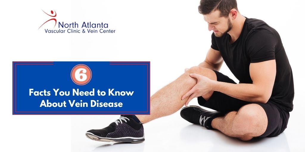 6 Facts You Need to Know About Vein Disease