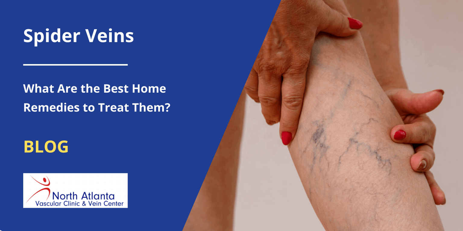 Spider Veins: What Are the Best Home Remedies to Treat Them?