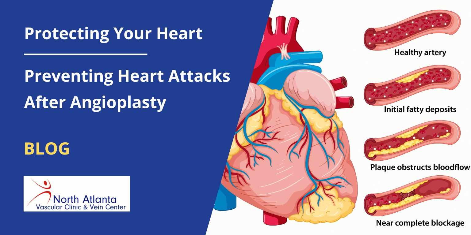 Protecting Your Heart: Preventing Heart Attacks After Angioplasty
