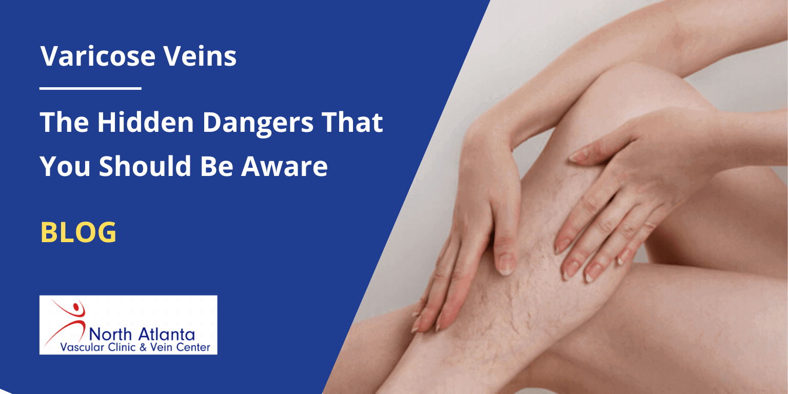 Varicose Veins: The Hidden Dangers That You Should Be Aware