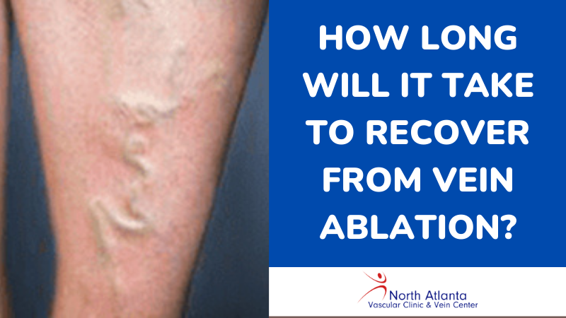 How Long Will It Take to Recover From Vein Ablation?