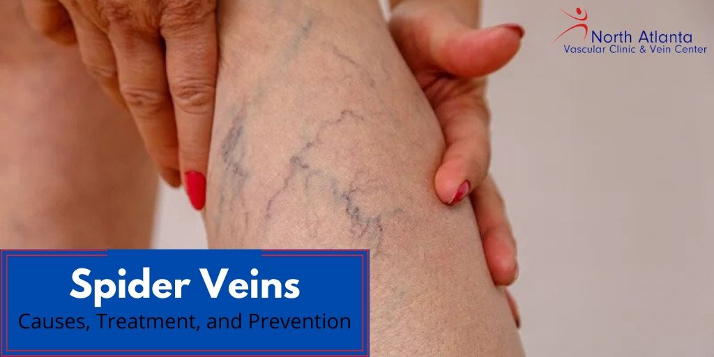 Spider Veins: Causes, Treatment, and Prevention