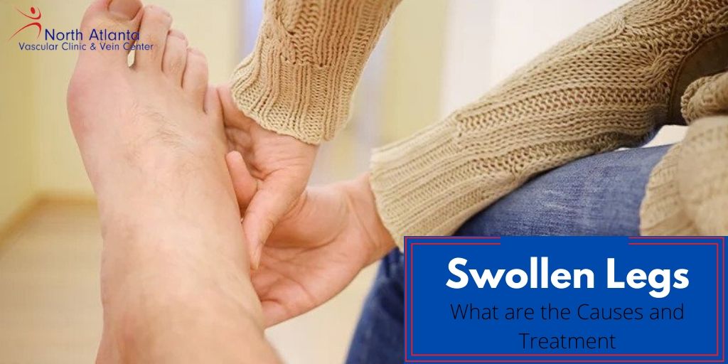 Swollen Legs: What Are the Causes and Treatments?