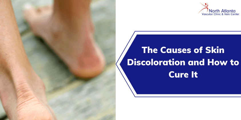 The Causes of Skin Discoloration and How to Cure It