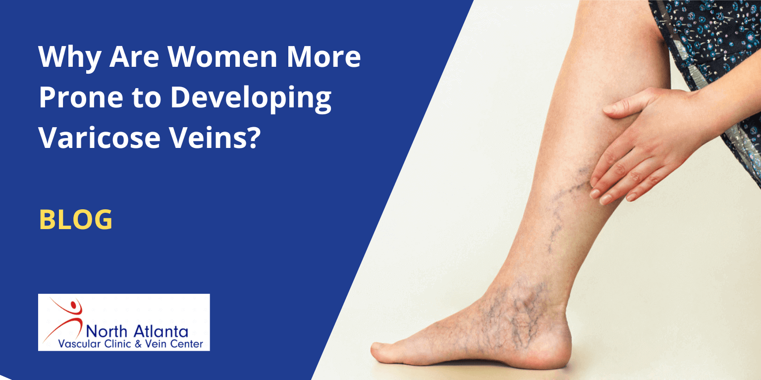 Why Are Women More Prone to Developing Varicose Veins?