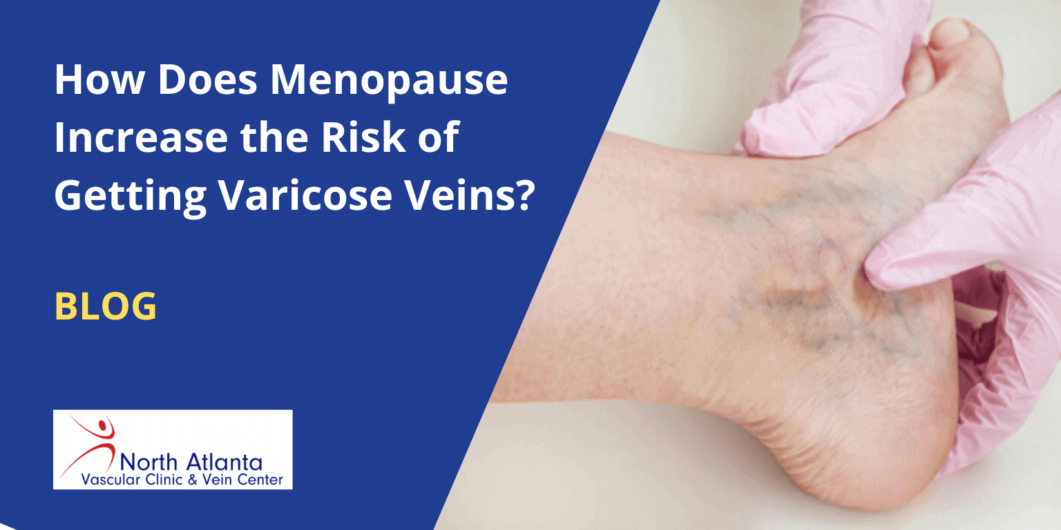 How Does Menopause Increase the Risk of Getting Varicose Veins