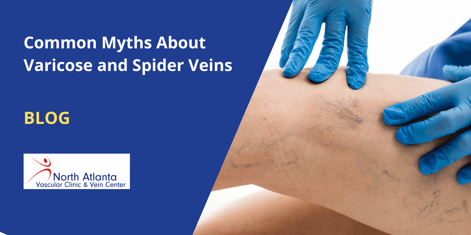 Common Myths About Varicose and Spider Veins