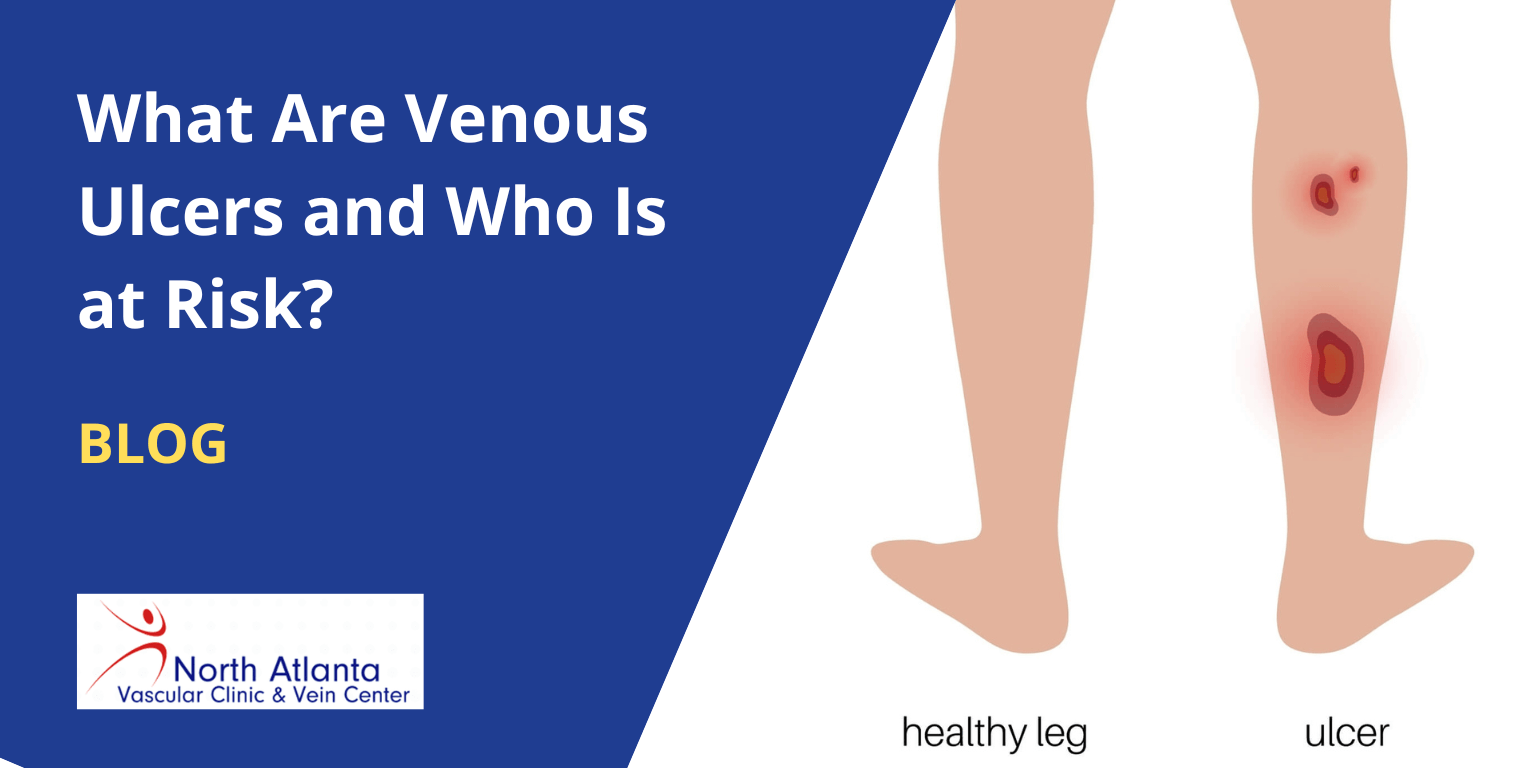 What Are Venous Ulcers and Who Is at Risk?