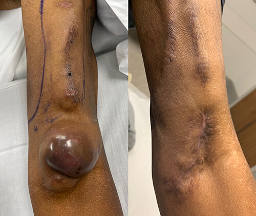 Arteriovenous Fistula