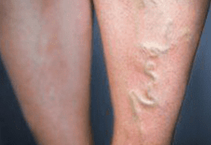 Sclerotherapy