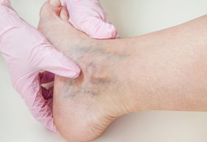 Vein Disease